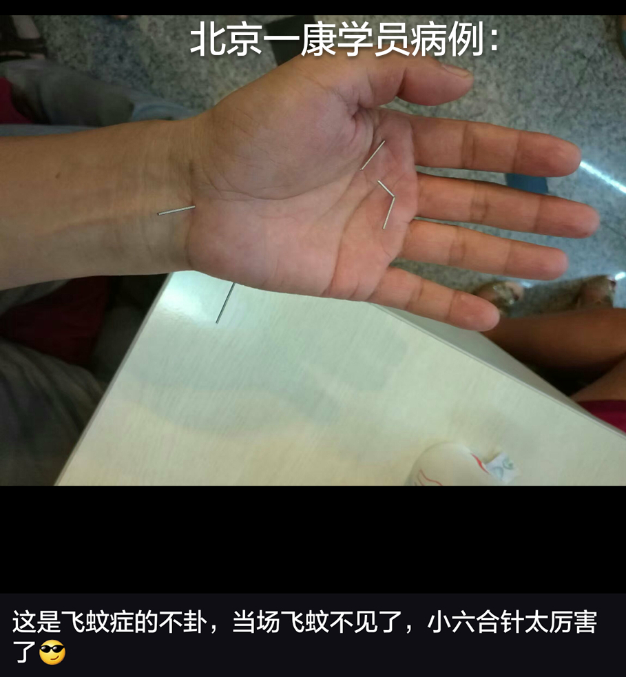 小六合针灸进针点图例(可以试做) 超微针刀,脉法针灸