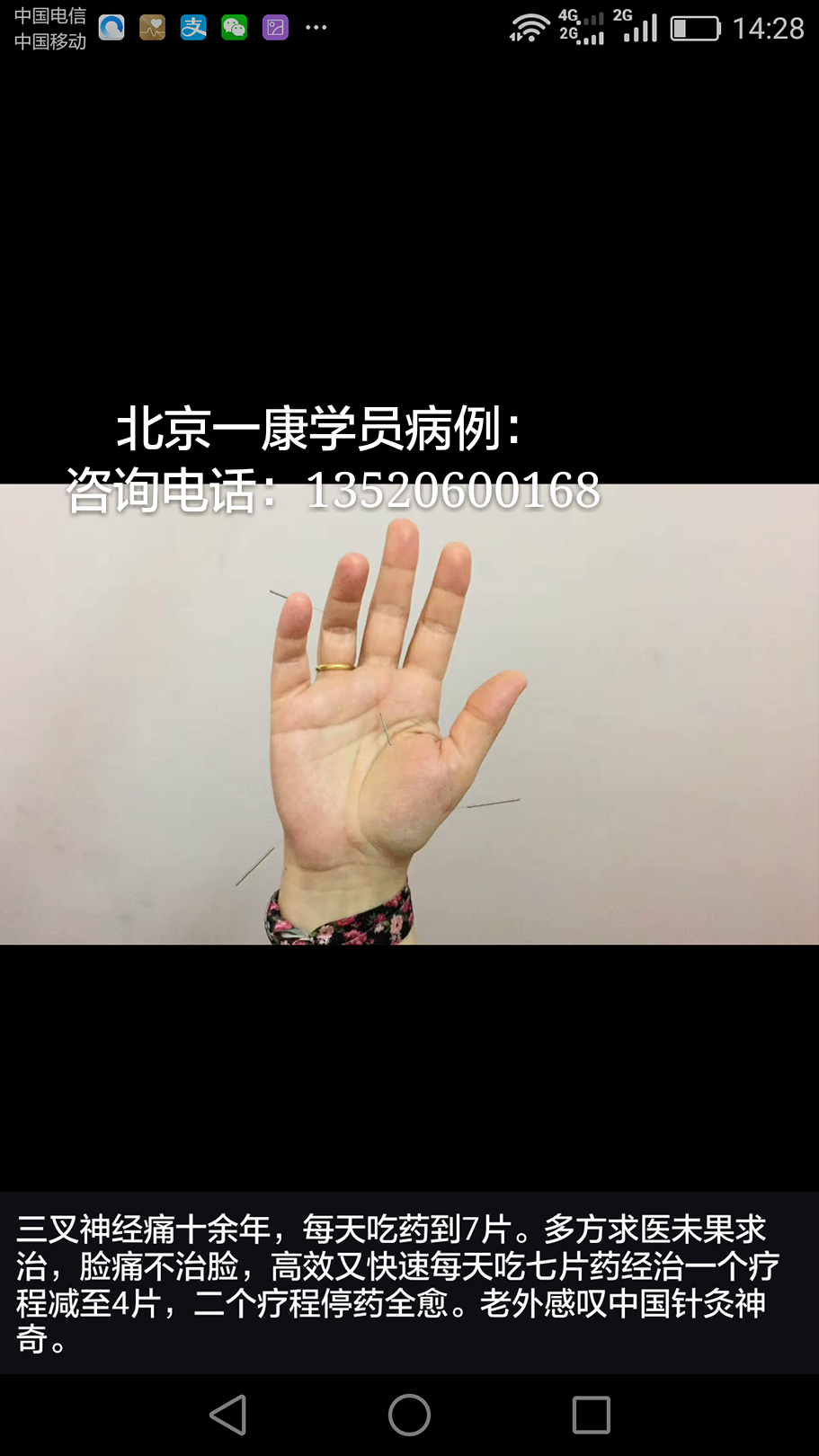 小六合针灸进针点图例(可以试做)
