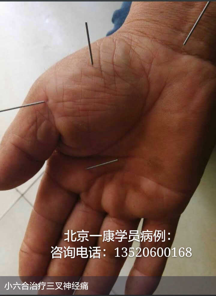 小六合针灸进针点图例(可以试做)