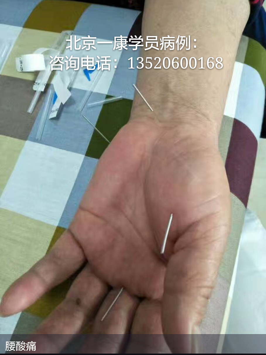 从内部群收集到北京一康小六合针法学员的病例,分享几十个,病例图示