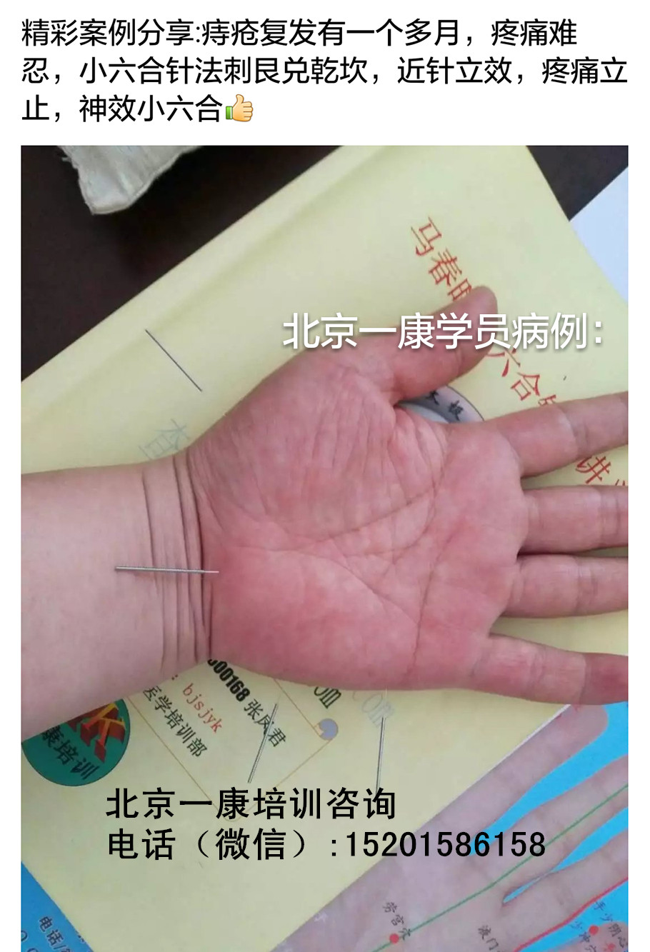 小六合进针手图--图文共享 超微针刀培训,脉法针灸,,.