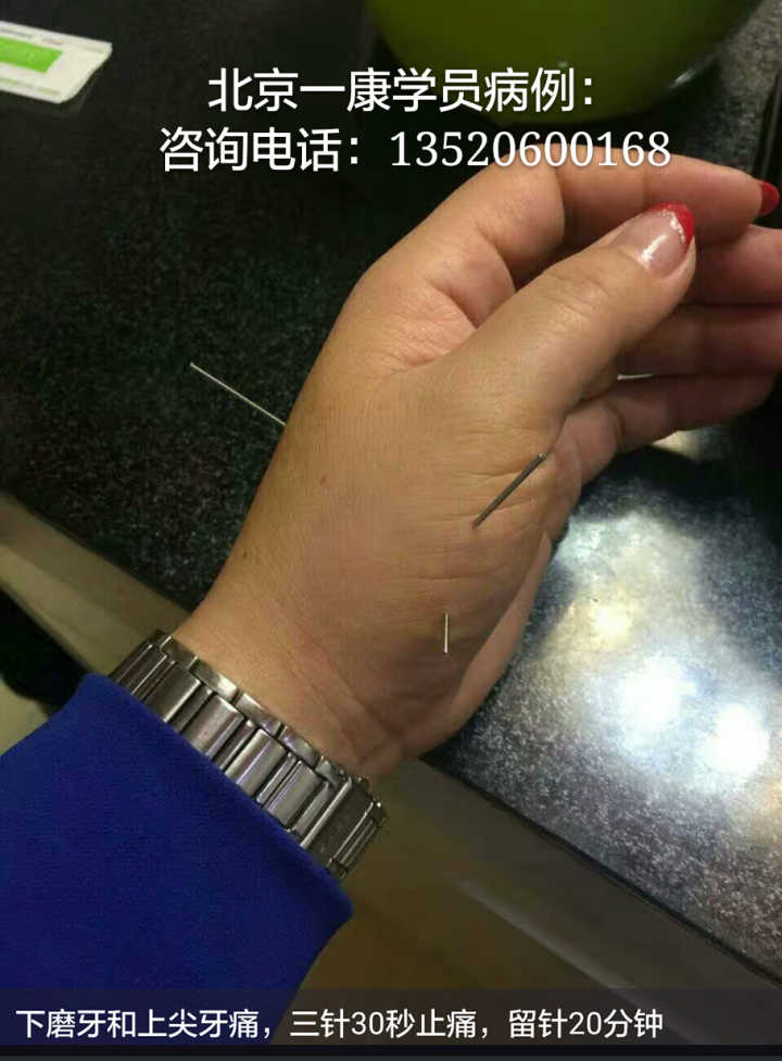小六合针灸进针点图例可以试做