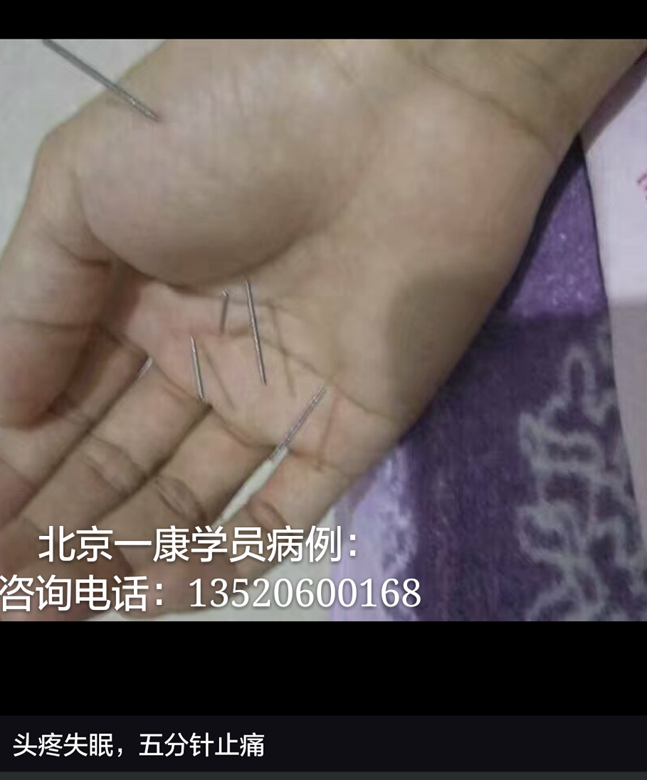 小六合针灸进针点图例(可以试做 超微针刀培训,脉法针灸培训,小小方