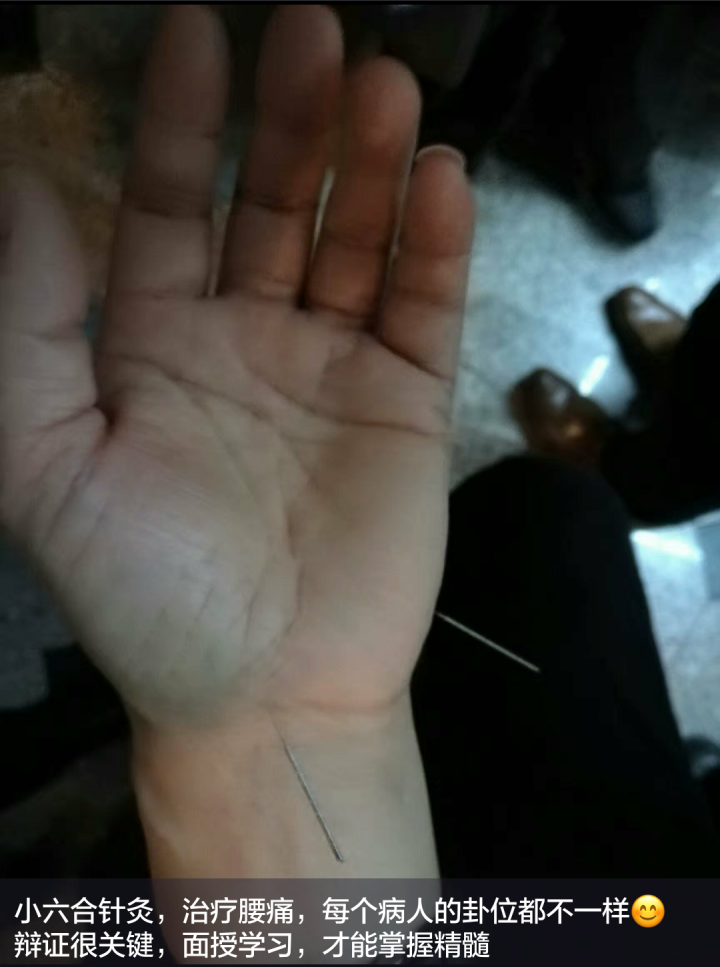 小六合针灸进针点图例(可以试做) 超微针刀培训,脉法针灸培训,小小方