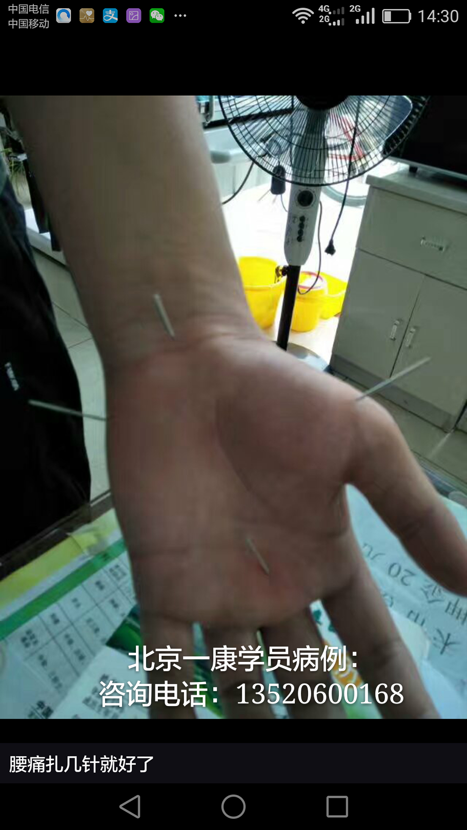 小六合针灸进针点图例(可以试做) 超微针刀培训,脉法针灸培训,小小方