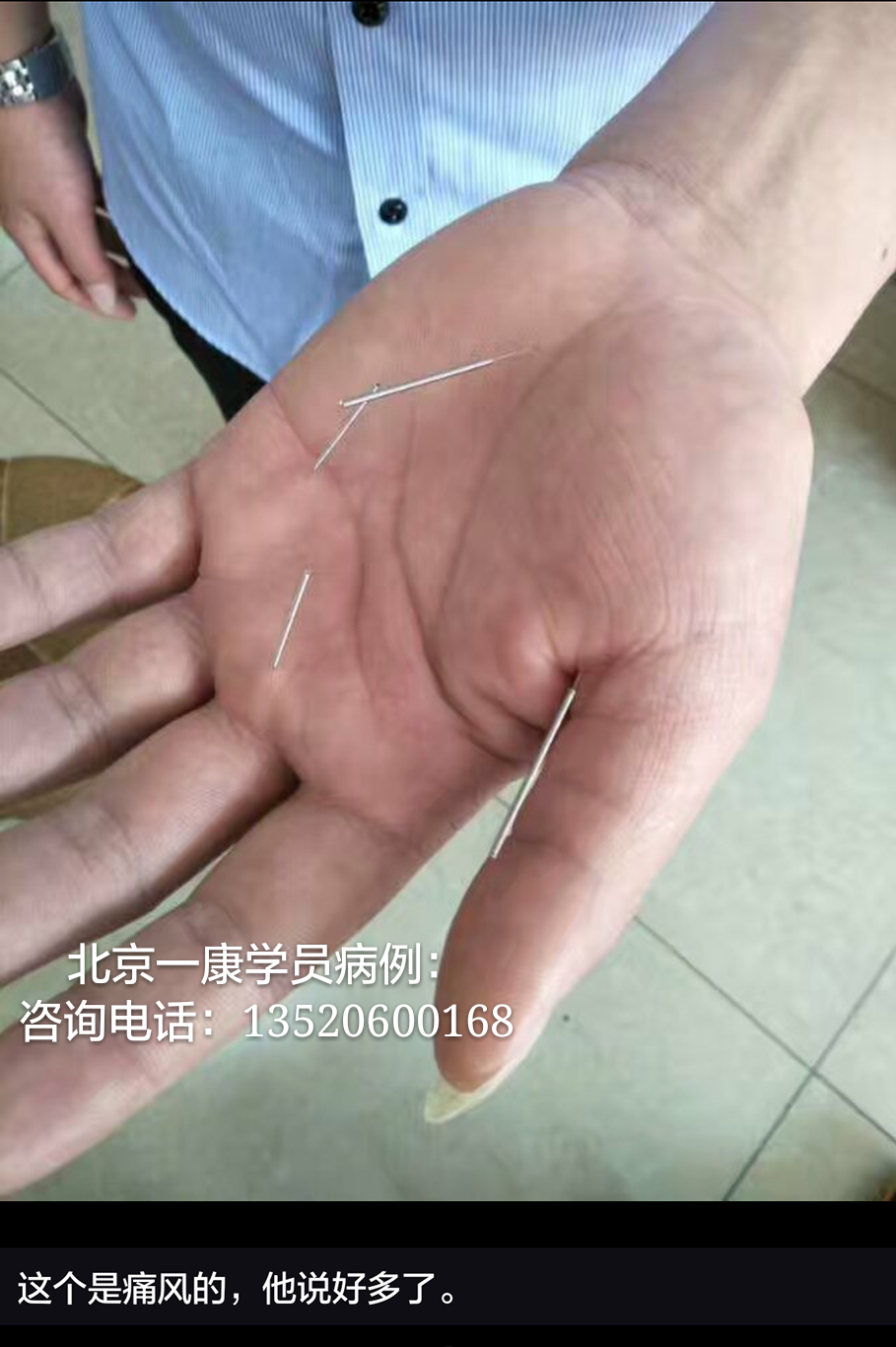 小六合针灸进针点图例(可以试做) 超微针刀培训,脉法针灸培训,小小方