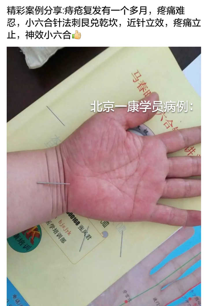 小六合针灸进针点图例(可以试做) 超微针刀培训,脉法针灸培训,小小方